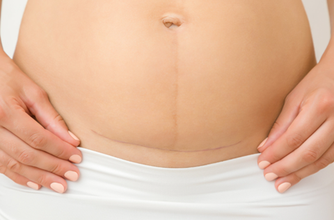 C-Section Scar Tissue Release Therapy - Cesarean Scar Massage